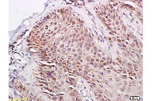 Formalin-fixed and paraffin-embedded human skin psoriasis labeled with Rabbit Anti- PPARrPolyclonal Antibody, unconjugated  (ABIN669711)  at 1: 200 followed by incubation with conjugated secondary antibody and DAB staining