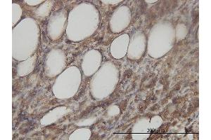 Immunoperoxidase of monoclonal antibody to ACY1 on formalin-fixed paraffin-embedded human malignant lymphoma, diffuse large B tissue. (Aminoacylase 1 anticorps  (AA 1-408))
