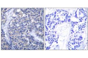Immunohistochemical analysis of paraffin-embedded human breast carcinoma tissue, using Zap-70 (Ab-319) antibody (E021173). (ZAP70 anticorps)