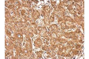 IHC-P Image HACL1 antibody detects HACL1 protein at cytosol on human hepatoma by immunohistochemical analysis.