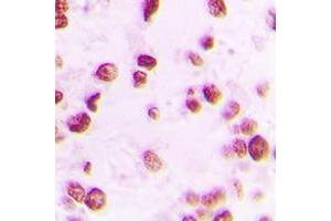 Immunohistochemical analysis of Artemis (pS516) staining in human lung cancer formalin fixed paraffin embedded tissue section.