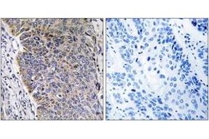 Immunohistochemistry analysis of paraffin-embedded human lung carcinoma tissue, using MGST3 Antibody. (MGST3 anticorps  (AA 8-57))