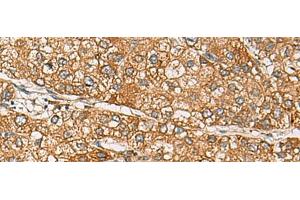 Immunohistochemistry of paraffin-embedded Human liver cancer tissue using DCAF12 Polyclonal Antibody at dilution of 1:65(x200) (DCAF12 anticorps)