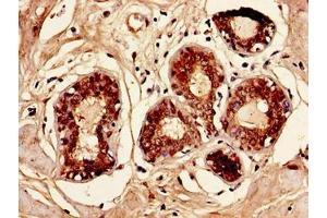 Immunohistochemistry of paraffin-embedded human breast cancer using ABIN7145972 at dilution of 1:100