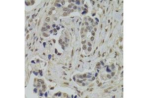 Immunohistochemistry of paraffin-embedded human breast cancer using INTS6 Antibody. (INTS6 anticorps  (AA 1-280))