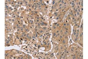 The image on the left is immunohistochemistry of paraffin-embedded Human breast cancer tissue using ABIN7191184(KCNJ15 Antibody) at dilution 1/35, on the right is treated with synthetic peptide.