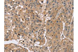 The image on the left is immunohistochemistry of paraffin-embedded Human breast cancer tissue using ABIN7191184(KCNJ15 Antibody) at dilution 1/35, on the right is treated with synthetic peptide. (KCNJ15 anticorps)