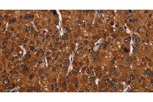 Immunohistochemistry of paraffin-embedded Human liver cancer tissue using RTN4R Polyclonal Antibody at dilution 1:50