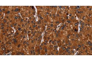 Immunohistochemistry of paraffin-embedded Human liver cancer tissue using RTN4R Polyclonal Antibody at dilution 1:50 (RTN4R anticorps)