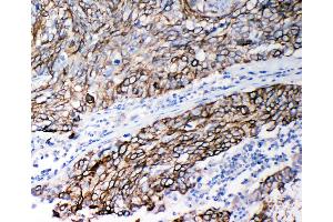 Anti-Stefin B antibody, IHC(P) IHC(P): Human Lung Cancer Tissue (CSTB anticorps  (Middle Region))