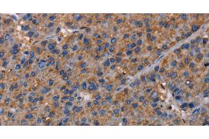Immunohistochemistry of paraffin-embedded Human liver cancer using NUP62 Polyclonal Antibody at dilution of 1:40 (NUP62 anticorps)