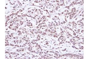 IHC-P Image Immunohistochemical analysis of paraffin-embedded A549 Xenograft, using SMC1A, antibody at 1:100 dilution. (SMC1A anticorps  (N-Term))