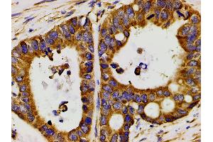 ABIN6267452 at 1/200 staining human colon cancer tissue sections by IHC-P. (PIK3R1 anticorps  (pTyr607))