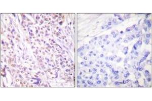 Immunohistochemistry analysis of paraffin-embedded human breast carcinoma tissue, using RAD17 (Ab-645) Antibody. (RAD17 anticorps  (AA 621-670))