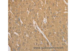 Immunohistochemistry of Human gastric cancer using CD40 Polyclonal Antibody at dilution of 1:70 (CD40 anticorps)