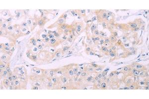 Immunohistochemistry of paraffin-embedded Human breast cancer tissue using ADCY7 Polyclonal Antibody at dilution 1:60 (ADCY7 anticorps)