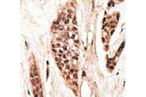 IHC analysis of FFPE human breast carcinoma tissue stained with the TAP1 antibody (TAP1 anticorps  (AA 765-794))