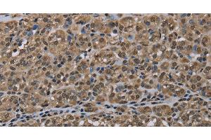 Immunohistochemistry of paraffin-embedded Human thyroid cancer tissue using NLRP6 Polyclonal Antibody at dilution 1:50