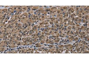 Immunohistochemistry of paraffin-embedded Human thyroid cancer tissue using NLRP6 Polyclonal Antibody at dilution 1:50 (NLRP6 anticorps)