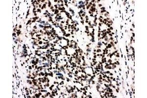 IHC-P: Ku80 antibody testing of human breast cancer tissue (XRCC5 anticorps  (C-Term))