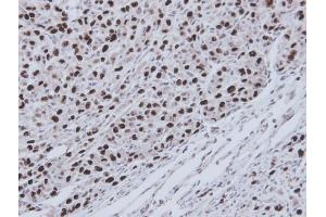 IHC-P Image Immunohistochemical analysis of paraffin-embedded U87 xenograft, using RecQ1, antibody at 1:100 dilution. (RecQ Protein-Like (DNA Helicase Q1-Like) (RECQL) (C-Term) anticorps)
