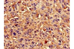 Immunohistochemistry of paraffin-embedded human melanoma using ABIN7144568 at dilution of 1:100 (ARAP3 anticorps  (AA 163-320))
