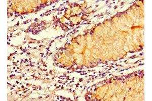 Immunohistochemistry of paraffin-embedded human colon cancer using ABIN7170420 at dilution of 1:100