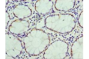 Immunohistochemistry of paraffin-embedded human colon cancer using ABIN7172096 at dilution of 1:100