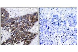 Immunohistochemical analysis of paraffin-embedded human breast carcinoma tissue using Connexin 43(Phospho-Ser367) Antibody(left) or the same antibody preincubated with blocking peptide(right).