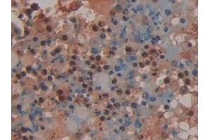 Detection of PR3 in Human Lung cancer Tissue using Polyclonal Antibody to Proteinase 3 (PR3)