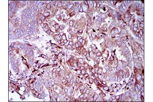 Immunohistochemical analysis of paraffin-embedded endometrial cancer tissues using SYCP3 mouse mAb with DAB staining.