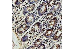 Immunohistochemical analysis of FBL5 staining in human colon cancer formalin fixed paraffin embedded tissue section. (FBXL4 anticorps)