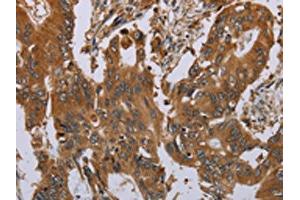 The image on the left is immunohistochemistry of paraffin-embedded Human colon cancer tissue using ABIN7191746(OSM Antibody) at dilution 1/40, on the right is treated with synthetic peptide. (Oncostatin M anticorps)