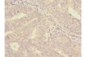 Immunohistochemistry of paraffin-embedded human endometrial cancer using ABIN7157058 at dilution of 1:100 (ISCU anticorps  (AA 1-167))