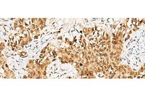 Immunohistochemistry of paraffin-embedded Human ovarian cancer tissue using CRCP Polyclonal Antibody at dilution of 1:65(x200)