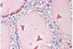 Human Thyroid (formalin-fixed, paraffin-embedded) stained with TG antibody ABIN396965 at 10 ug/ml followed by biotinylated anti-mouse IgG secondary antibody ABIN481714, alkaline phosphatase-streptavidin and chromogen.