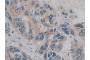 Detection of H2AFY in Human Breast cancer Tissue using Polyclonal Antibody to H2A Histone Family, Member Y (H2AFY)