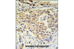ADFP Antibody IHC analysis in formalin fixed and paraffin embedded breast carcinoma followed by peroxidase conjugation of the secondary antibody and DAB staining. (ADRP anticorps  (AA 186-214))