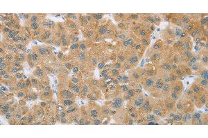 Immunohistochemistry of paraffin-embedded Human liver cancer tissue using CYP2C9 Polyclonal Antibody at dilution 1:35