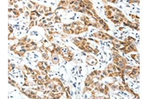 The image on the left is immunohistochemistry of paraffin-embedded Human lung cancer tissue using ABIN7130157(MAP3K14 Antibody) at dilution 1/30, on the right is treated with fusion protein. (MAP3K14 anticorps)