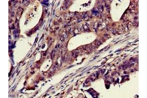 Immunohistochemistry of paraffin-embedded human colon cancer using ABIN7150733 at dilution of 1:100 (Mps1 anticorps  (AA 370-492))