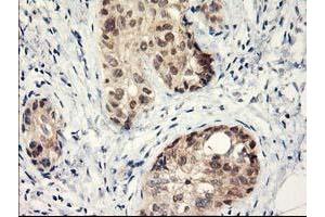 Immunohistochemical staining of paraffin-embedded Adenocarcinoma of Human breast tissue using anti-LPL mouse monoclonal antibody. (Lipoprotein Lipase anticorps  (AA 28-475))