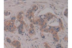 Detection of PSG1 in Human Breast cancer Tissue using Polyclonal Antibody to Pregnancy Specific Beta-1-Glycoprotein 1 (PSG1) (PSG1 anticorps  (AA 202-401))