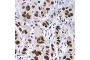 Immunohistochemistry of paraffin-embedded human gastric cancer using SF3B2 antibody (ABIN5973482) at dilution of 1/100 (40x lens). (SF3B2 anticorps)