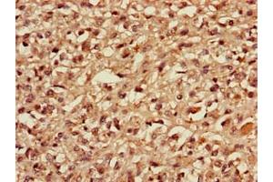Immunohistochemistry of paraffin-embedded human melanoma using ABIN7159613 at dilution of 1:100 (MBD3 anticorps  (AA 79-209))
