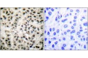 Immunohistochemistry analysis of paraffin-embedded human breast carcinoma tissue, using MEF2A (Ab-408) Antibody.