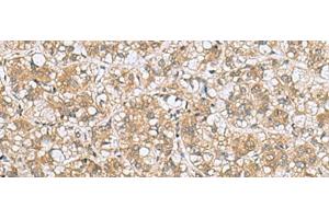 Immunohistochemistry of paraffin-embedded Human liver cancer tissue using LFNG Polyclonal Antibody at dilution of 1:60(x200) (LFNG anticorps)