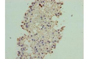Immunohistochemistry of paraffin-embedded human breast cancer using ABIN7144801 at dilution of 1:100 (ATXN7L1 anticorps  (AA 1-146))