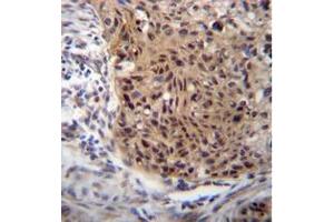 Formalin fixed and paraffin embedded human esophageal carcinoma reacted with EXTL3 Antibody (N-term) followed by peroxidase conjugation of the secondary antibody and DAB staining. (EXTL3 anticorps  (N-Term))