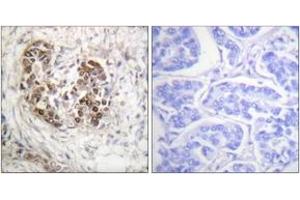 Immunohistochemistry analysis of paraffin-embedded human breast carcinoma tissue, using p53 (Ab-20) Antibody. (p53 anticorps  (AA 10-59))